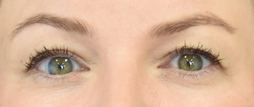 Eyelid Surgery Patient 9 Set 1 Before